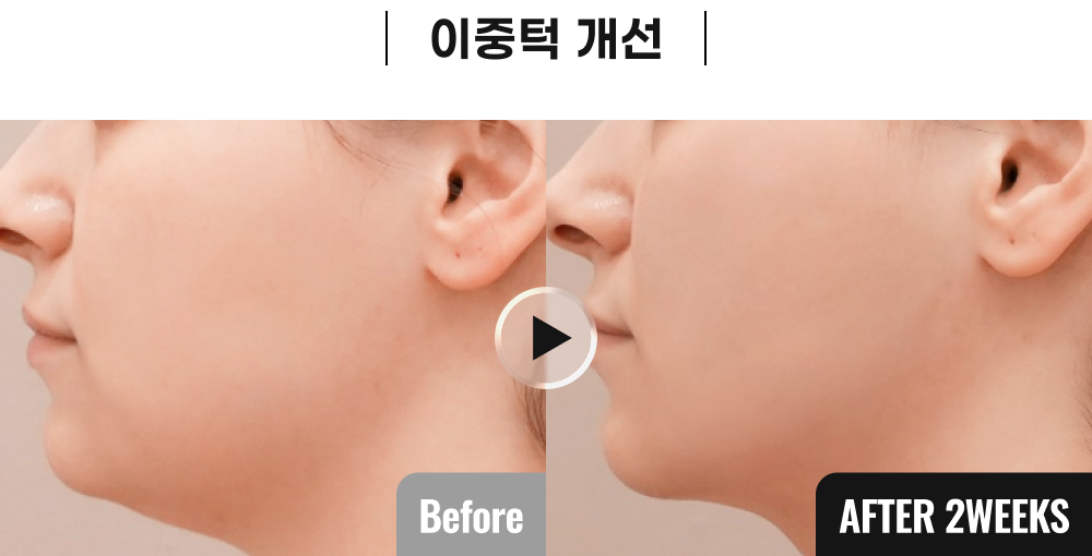 올타이트 시술 전후사진 1