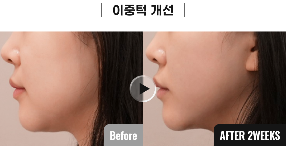 올타이트 시술 전후사진 3