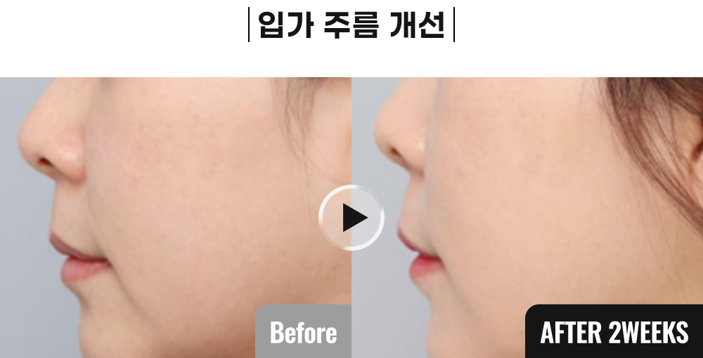 올타이트 시술 전후사진 4